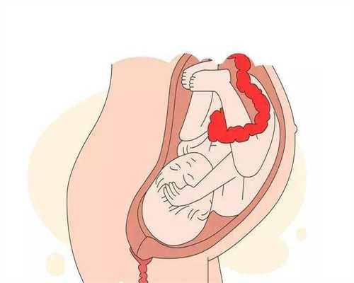 女孩肚子突然变大，却不是因为代孕，检查得知